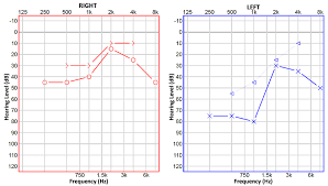 Image result for Ossicular Chain Disruption