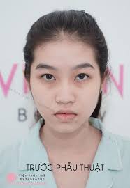 🇲🇦 BÓC PHỐT BẠN NỮ: ✓ Nâng Mũi Cấu Trúc ✓ Cắt Mắt ✓ Mở Góc Mắt ⁉️ TRỞ  THÀNH H.O.T GIRL TRONG 7 NGÀY LÀ THẬT Ở VIVIAN ⁉️ 💢LÀM ĐẸP