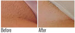 Come summertime, many people turn to bikini waxes for hair removal. Ingrown Hair Removal Nyc Ingrown Hair Treatment Brooklyn