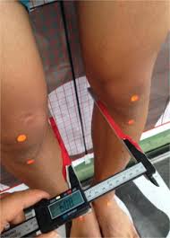 Image result for Genu Varum