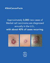 Image result for Merkel Cell Carcinoma