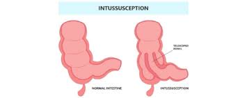 Image result for Intussusception