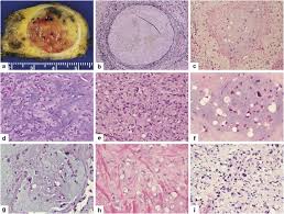 A tumor diameter of 3 cm or greater. Malignant Vascular Tumors An Update Modern Pathology