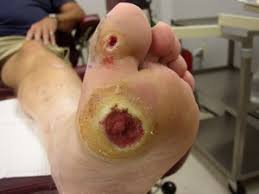 Image result for diabetes