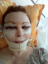 Face Lift ,neck lift Fat Transfer , Brow Lift , Upper Eye Lift