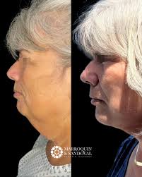 💫 ¿Te gustaría lucir más joven y fresca? Entonces el Facelift es para ti  💉✨ Este procedimiento es ideal si buscas un rejuvenecimiento facial  natural, sin perder tu esencia y con resultados