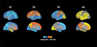 Several causative gene defects (e.g., amyloid precursor protein gene mutations) and risk factors (e. Vier Subtypen Von Alzheimer Identifiziert Verteilung Der Tau Proteine Bedingt Unterschiedliche Symptome Und Prognose Scinexx De