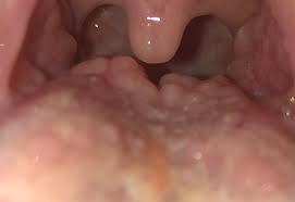 Image result for Puchýře na jazyku