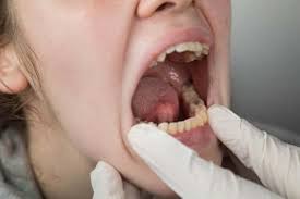 Women and people of 45 years of age and above are more vulnerable to. Risk Factors For Mouth Cancer Step To Health