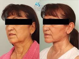 Mesa hills, el paso texas 79912. No Visible Scars Neck Lift By El Paso Cosmetic Surgery Facebook