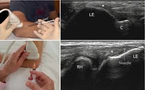 Image result for Epicondyle Injection