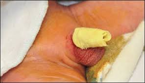 Image result for Neonatal Circumcision