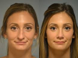 Facial Plastic Surgery in Philadelphia, PA