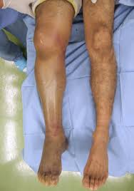 Image result for Compartment Syndrome