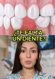 Consecuencias de la extrusión dental: ¿Qué pasa si me falta un diente y no  lo sustituyo?