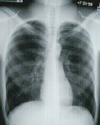 Image result for Chest XRay