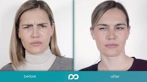 Botox Nichtchirurgische Behandlungen Behandlungen Poliklinik Milojevic