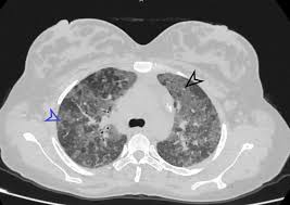 Cureus Rheumatoid Arthritis Related Interstitial Lung Disease Patterns Of High Resolution Computed Tomography