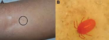Image result for Trombicula autumnalis bites