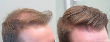 The decrease in dht helps prevent your prostate. Propecia Rogaine Before After Photos Bernstein Medical