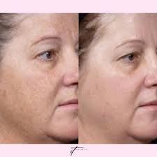 TOP 10 BEST Botox Injections near Egg Harbor Township, NJ