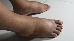 Image result for toe black diabetes
