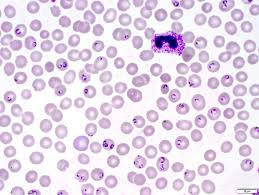 Peripheral blood smear shows trophozoites and schizonts within erythrocytes. Pathology Outlines Plasmodium Falciparum