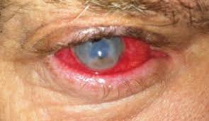 Image result for Acute Red Eye