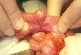 About 1% of colon polyps will become colon cancer. Meckel Diverticulum Cancer Therapy Advisor