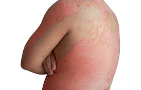 Image result for Radiation Dermatitis