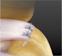 The shape of the acromion had been initially divided into three types (which was known as the bigliani classification) 3, to which a fourth acromion morphology (types) are based on sagittal oblique mri Schulter Orthopadie Sportmedizin Efringen Kirchen