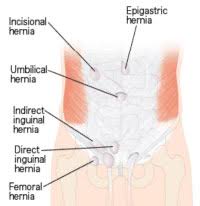 The recommendation is to see your doctor. Hernias And Peritoneal Dialysis Home Dialysis Central