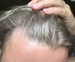 Top 10 Hair Transplant Near Me Best Hair Transplant Hair Transplant Surgery Hair Transplant
