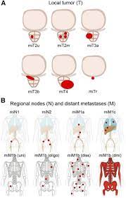 Please understand that our pho. Prostate Cancer Molecular Imaging Standardized Evaluation Promise Proposed Mitnm Classification For The Interpretation Of Psma Ligand Pet Ct Journal Of Nuclear Medicine
