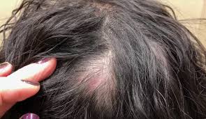 The only solution to this issue is to have the cyst removed. Pimple Popping Video This Woman Had Her Scalp Cyst Removed Hellogiggles