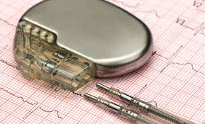 A pacemaker is a small device that's placed under the skin in your chest to help control your heartbeat. Herzschrittmacher Defibrillatoren Kardiovaskulares Zentrum Darmstadt