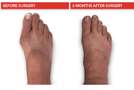 You should avoid getting your stitches wet. Surgeons At Foot Ankle Center Of Iowa Midwest Bunion Centers Lead The Way In Bunion Surgery Foot Ankle Center Of Iowa Podiatrists