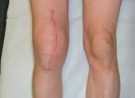 Arthrofibrose Trotz Neuer Therapie Zu Selten Erkannt