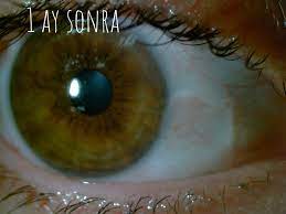 pterjium dr baris sonmez goz hastaliklari uzmani