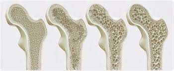 Bone is living tissue that is constantly being broken down and replaced. Approaches To Treating Osteoporosis