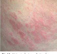 Image result for Radiation Dermatitis