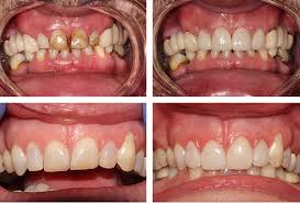 In turkey, the veneers prices turkey are beneficial, which is due to the cooperation of travel companies with specialized clinics. Veneers Essex Dental Veneer Cost Essex Street Farm Dental
