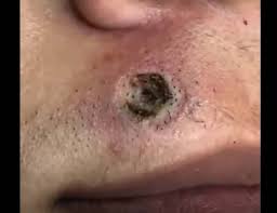 What are symptoms or treatment? Ingrown Hair Staph Infection Archives New Pimple Popping Videos