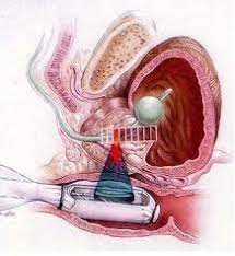 High Intensity Focused Ultrasound Hifu For Prostate Cancer