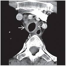 Image result for Relapsing Polychondritis