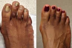 Explore Information About Corn Removal Surgery In This Post You Will Find Information On Corn Removal Surg Corn Removal Surgery Corn Removal Toe Corn Removal