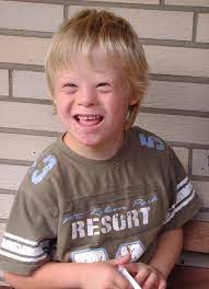 Down syndrome - Wikipedia
