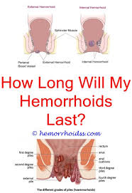 Too much fiber too fast can cause gas and bloating, so add a little bit to your diet at a time if you're not used to it. Pin On External Hemorrhoid Treatment
