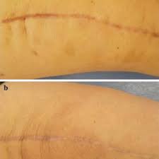 The hives disappeared after a day. Comparing Steri Strip And Surgical Staple Wound Closures After Primary Total Knee Arthroplasties Request Pdf