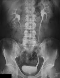 Intravenous Pyelogram Intravenous Pathology Urinary Tract Infection